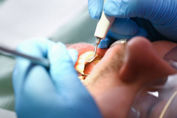 Best Knocked-Out Tooth (Avulsed Tooth) Treatment in El Segundo, CA